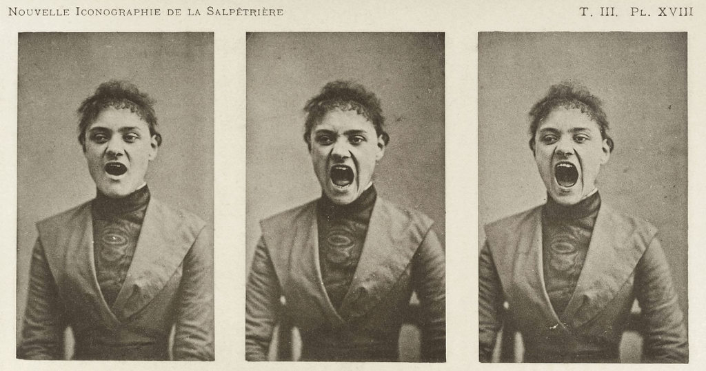 A patient at French psychiatrist Jean-Martin Charcot's Salpêtrière Hospital, where doctors studied hysteria, then thought to be an inherited disease of the nerves. (Wikimedia Commons)